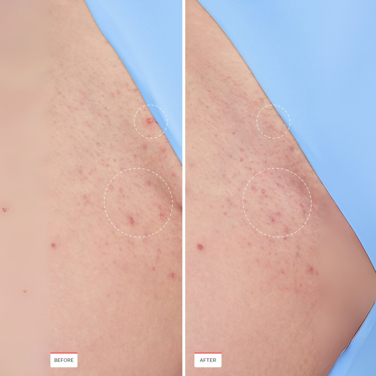 Ingrown Hair Smoothing Serum