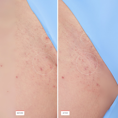 Ingrown Hair Smoothing Serum